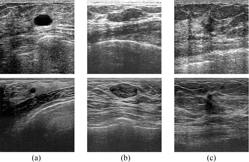 Breast_Ultrasound_DatasetB_0.png