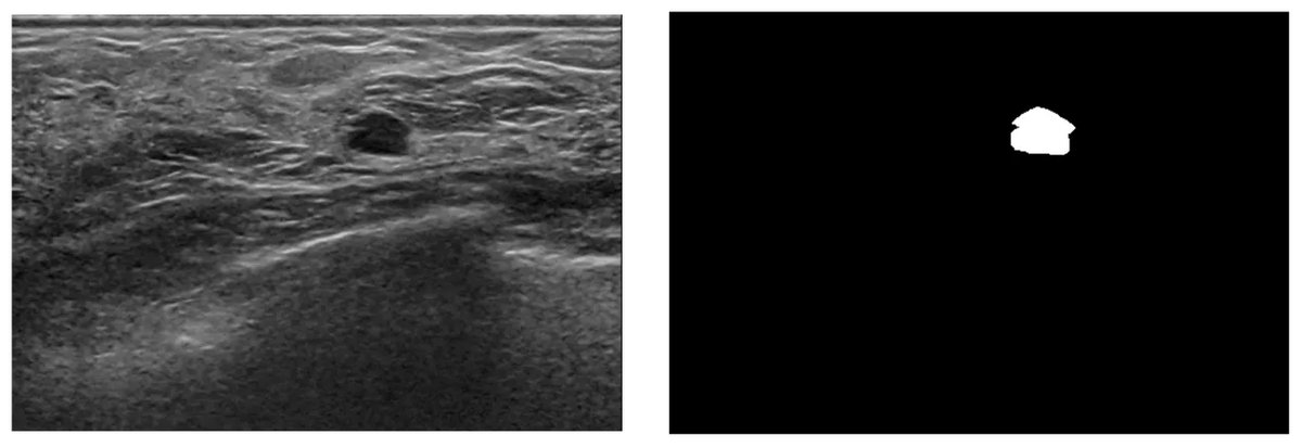 Breast_Ultrasound_DatasetB_2.webp