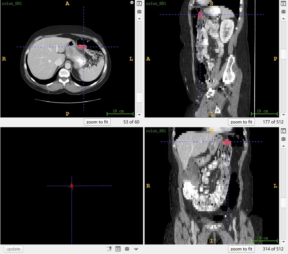 MSD_Colon_Cancer_1.webp
