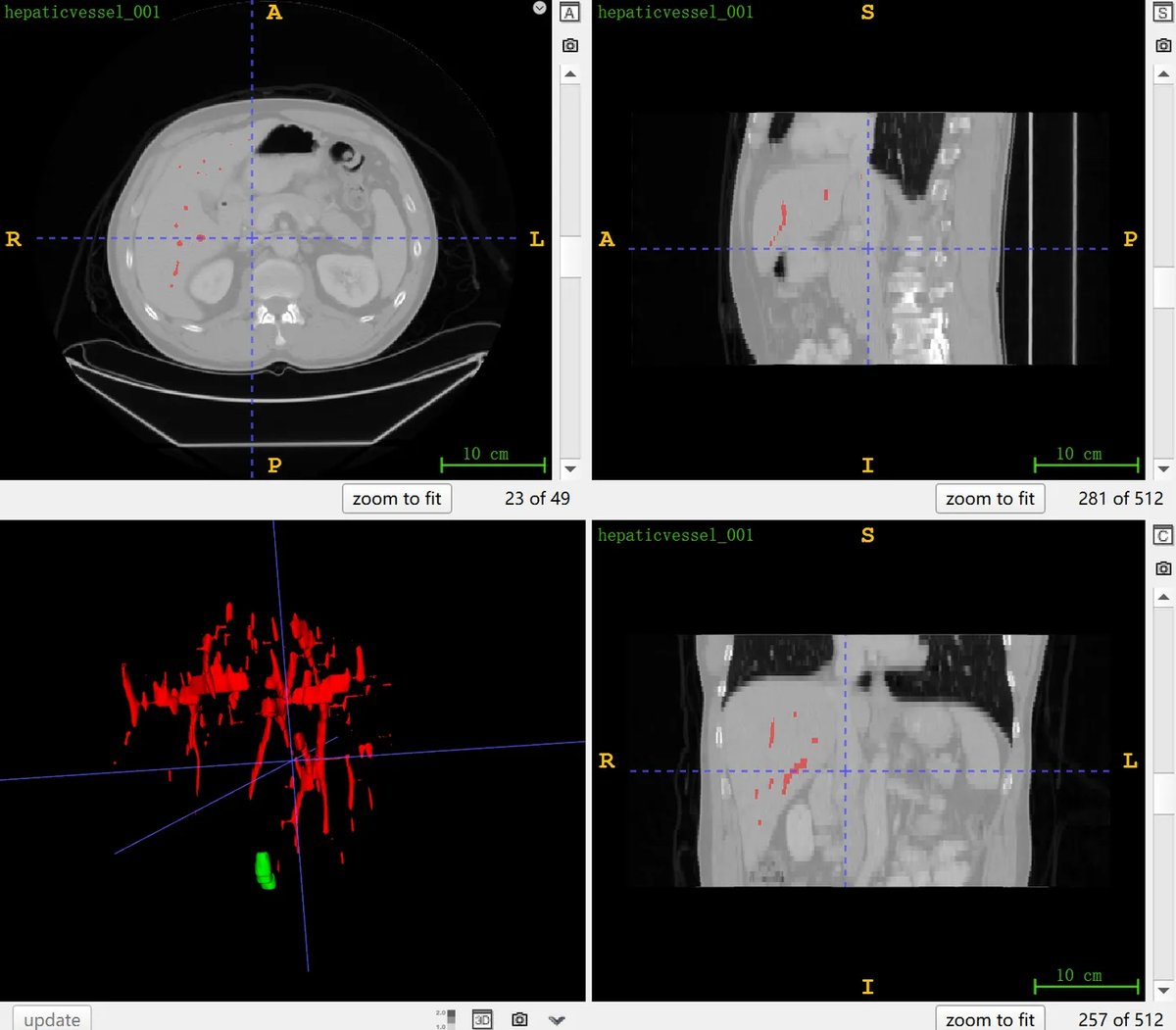 MSD_Hepatic_Vessel_1.webp