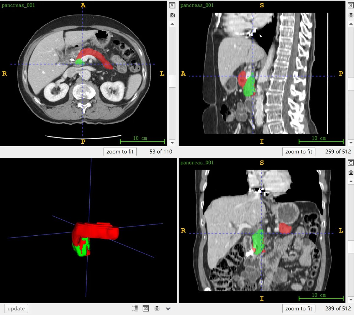 MSD_Pancreas_Tumour_1.webp