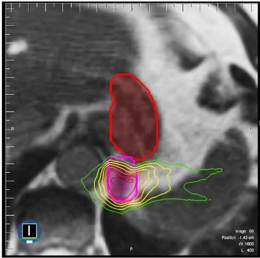 UW-Madison_GI_Tract_Image_Segmentation_2.webp