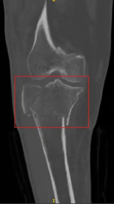 FracturedBoneDetection_3.webp