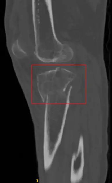 FracturedBoneDetection_2.webp