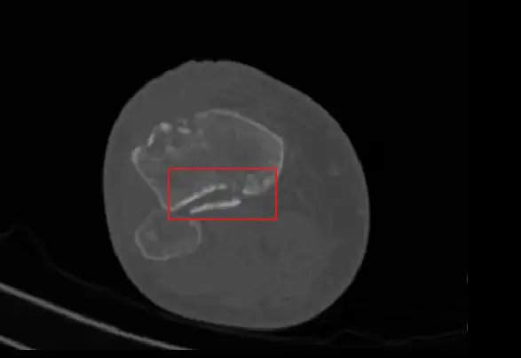 FracturedBoneDetection_1.webp