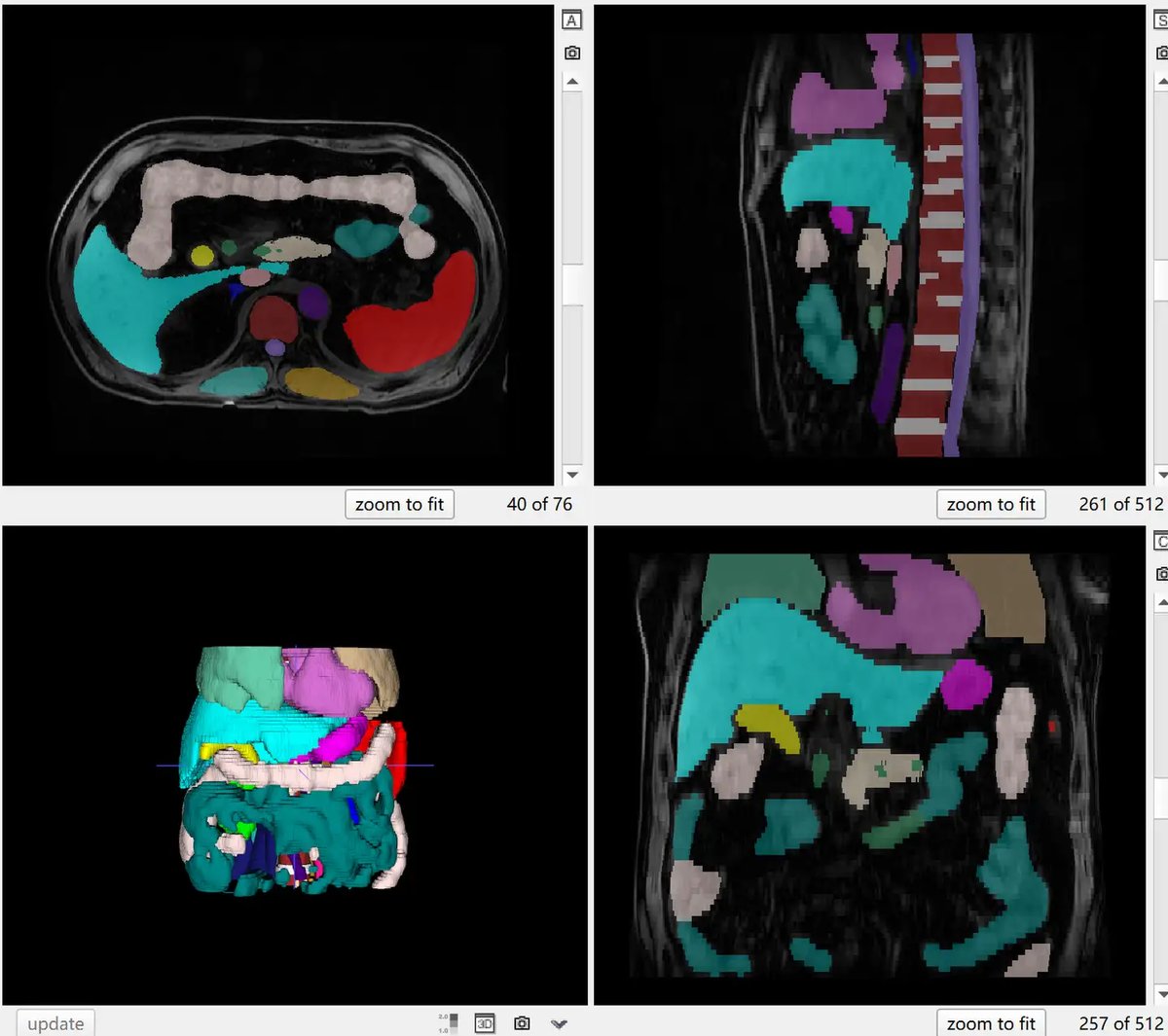 TotalSegmentator_MRI_2.webp