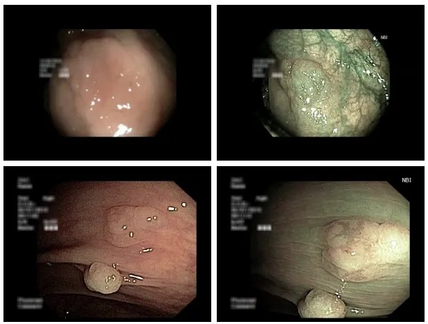 Colonoscopic_2.webp
