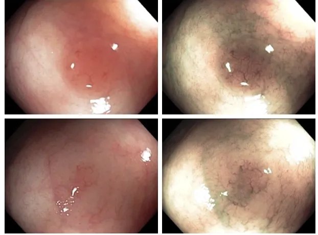 Colonoscopic_1.webp