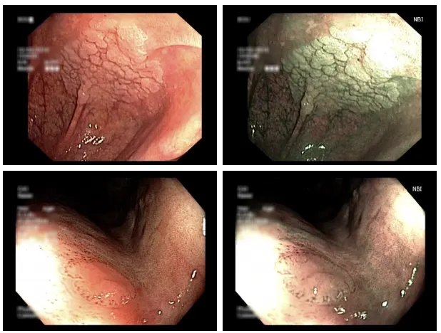 Colonoscopic_3.webp