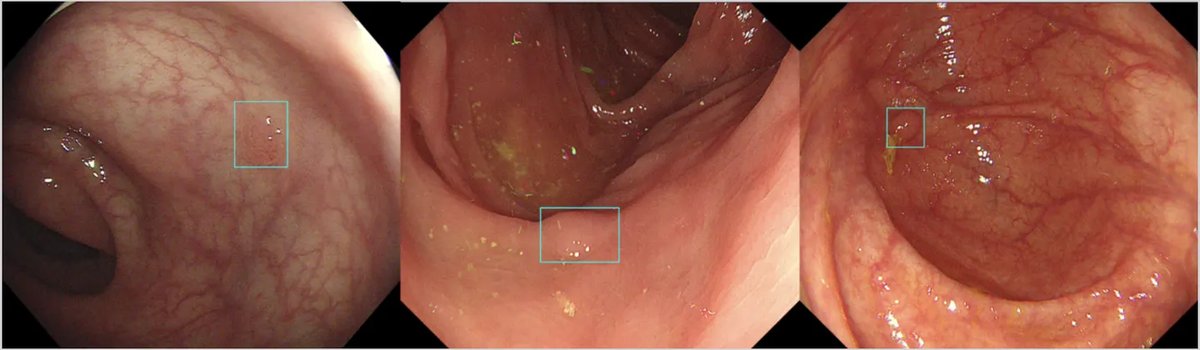 SUN_Colonoscopy_Video_1.webp