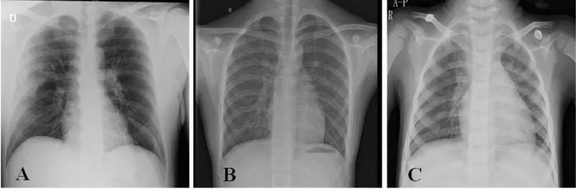 COVID-19_CHEST_X-RAY_DATABASE_1.webp