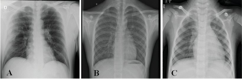 COVID-19_CHEST_X-RAY_DATABASE_0.png