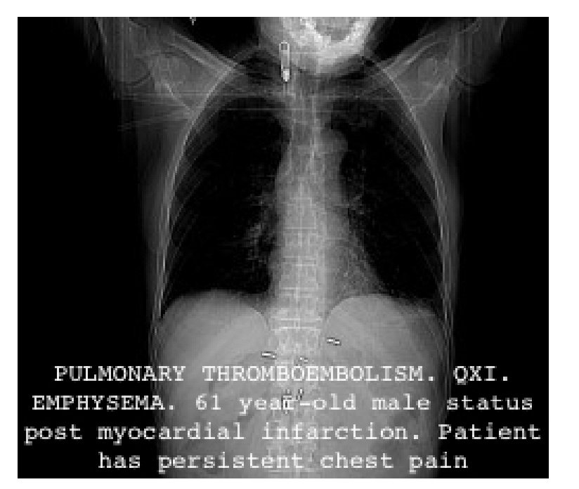 IU-Xray_0.png