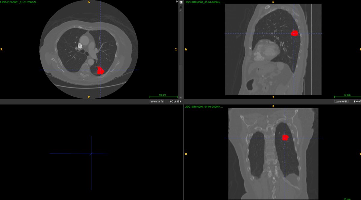 DICOM-LIDC-IDRI-Nodules_0.png