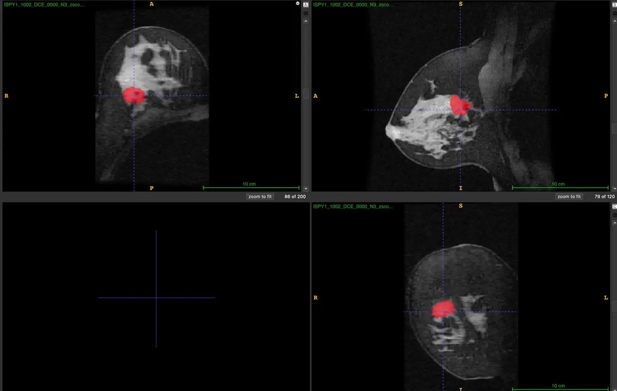 ISPY1-Tumor-SEG-Radiomics_1.webp