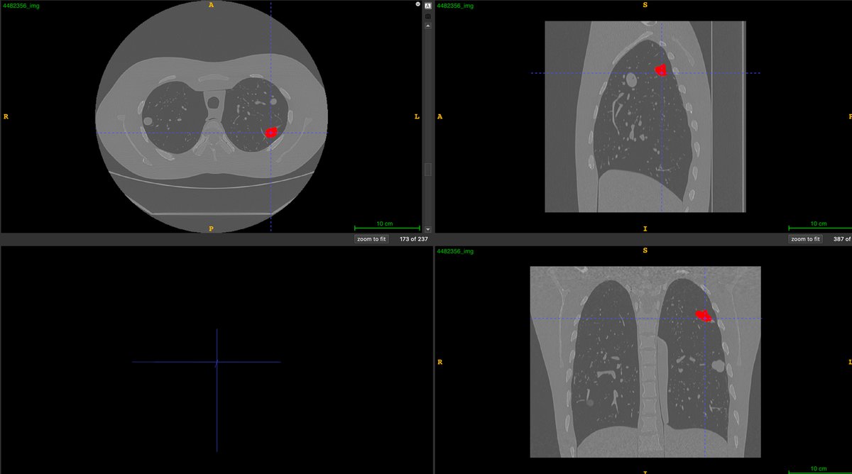 QIN-LungCT-Seg_1.png