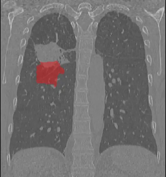 RIDER-LungCT-Seg_3.webp