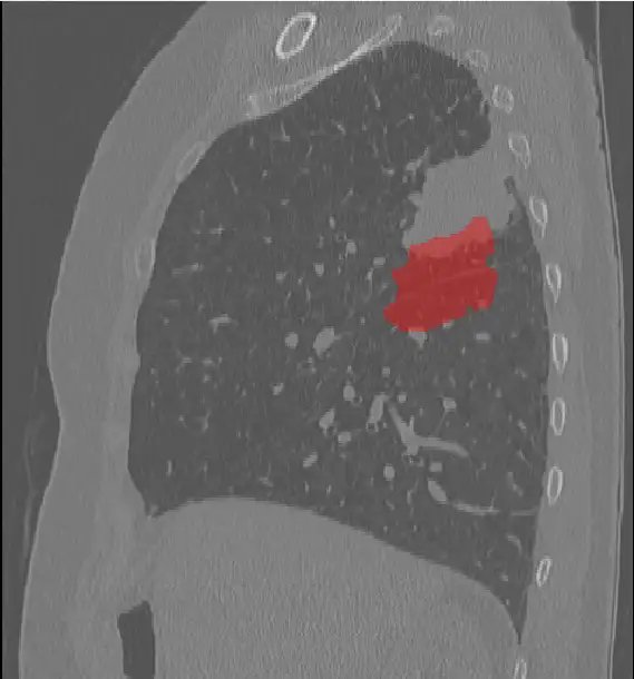 RIDER-LungCT-Seg_2.webp
