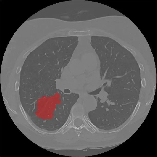 RIDER-LungCT-Seg_1.webp