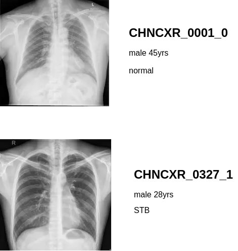 Shenzhen_chest_X-ray_1.webp