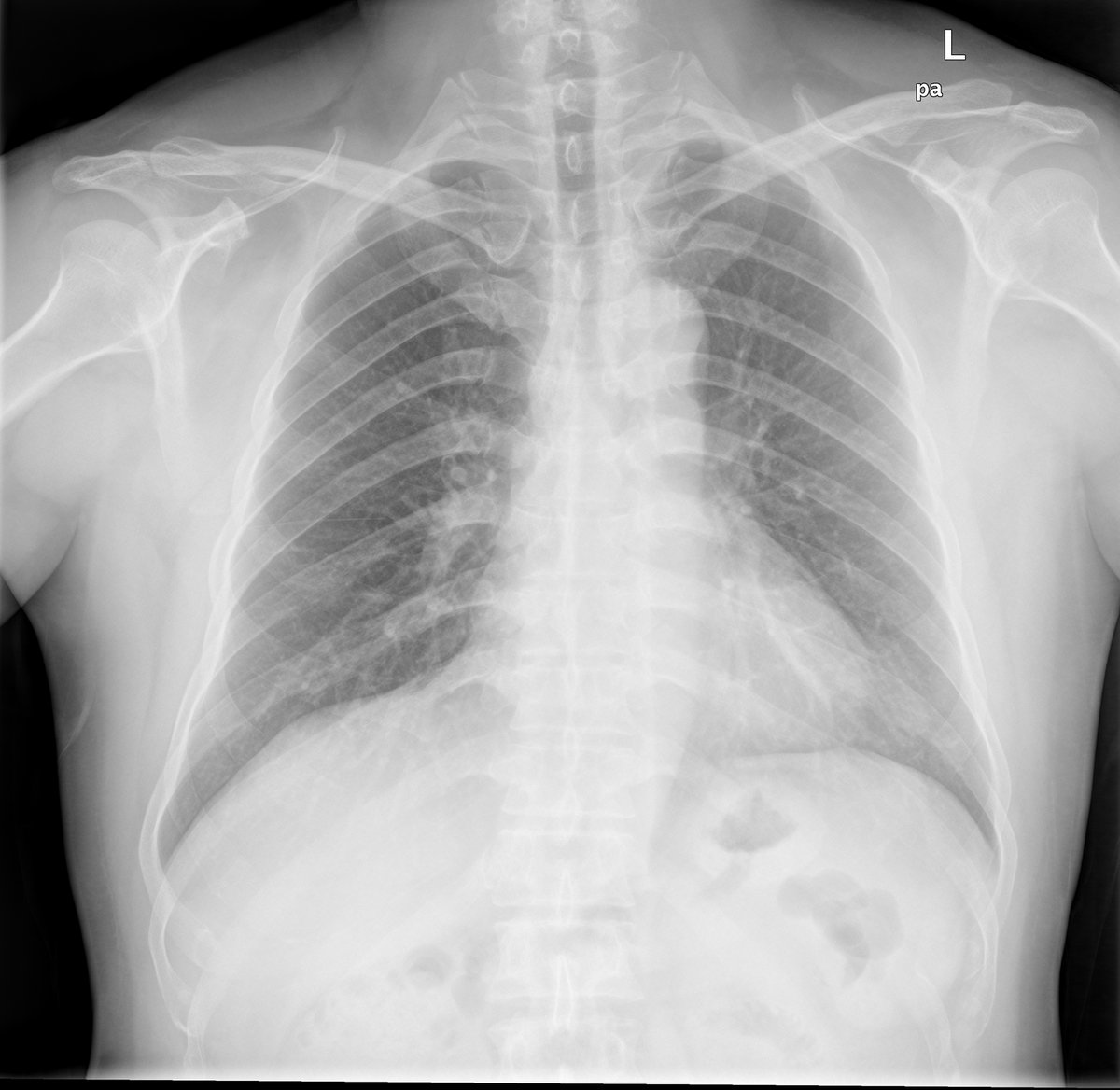 Shenzhen_chest_X-ray_0.png