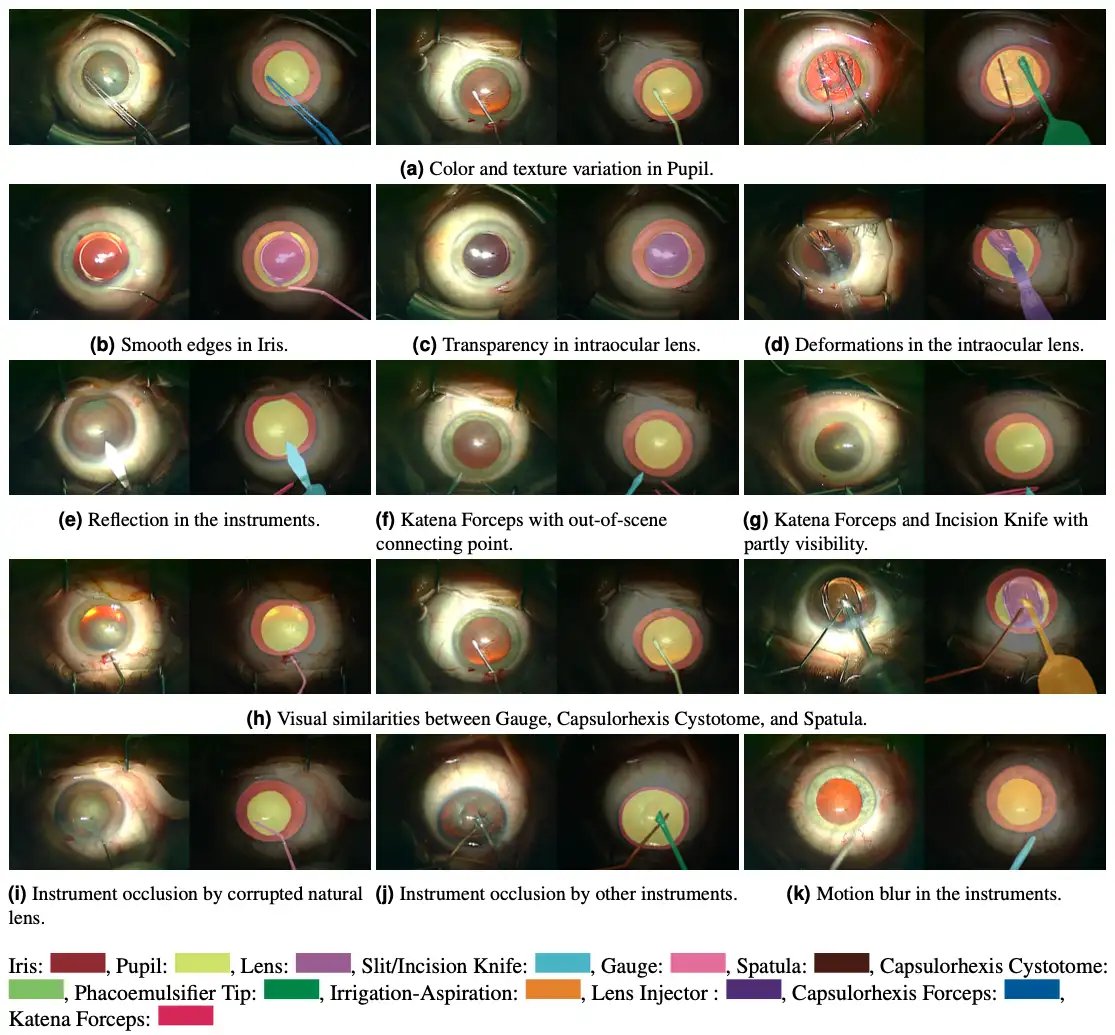 Cataract-1K_4.webp