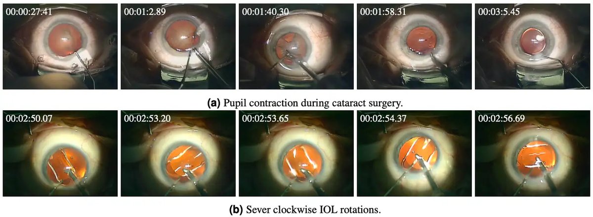 Cataract-1K_5.webp