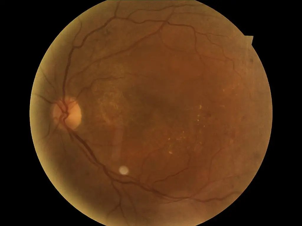 DiabeticRetinopathyArranged_4.webp