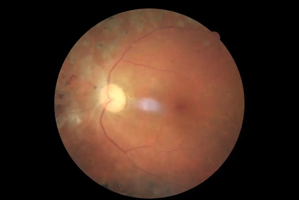 DiabeticRetinopathyArranged_5.webp