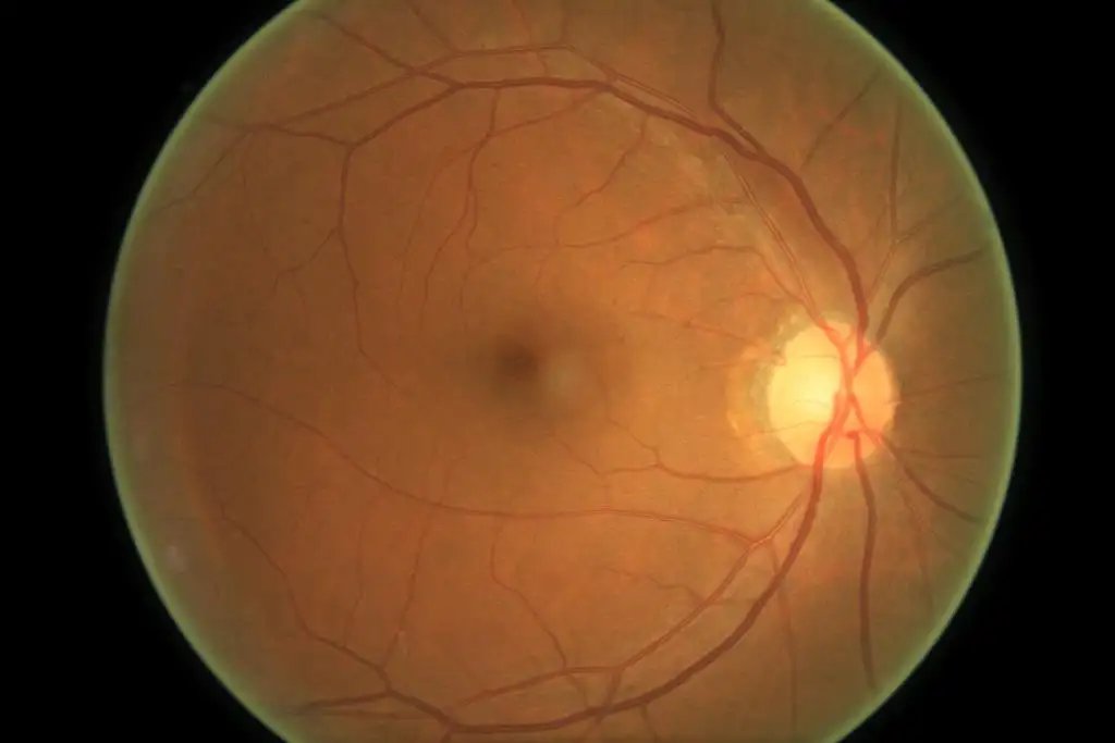 DiabeticRetinopathyArranged_3.webp
