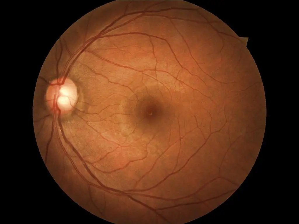 DiabeticRetinopathyArranged_1.webp