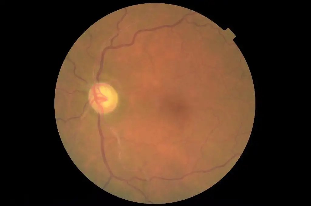 DiabeticRetinopathyArranged_2.webp