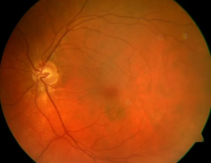 Multi-LabelRetinalDiseases_1.webp
