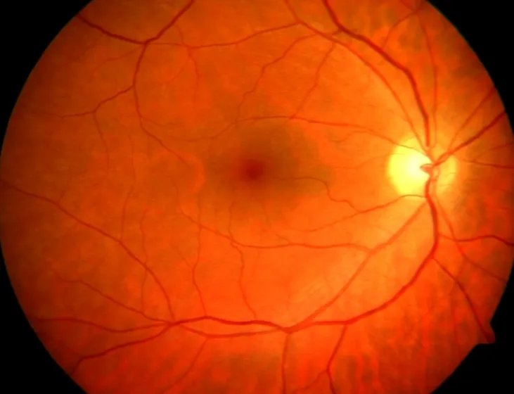 Multi-LabelRetinalDiseases_2.webp