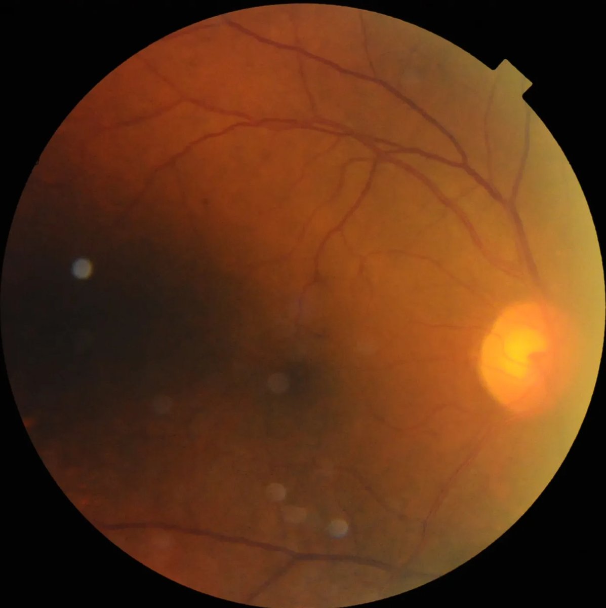 Multi-LabelRetinalDiseases_3.webp