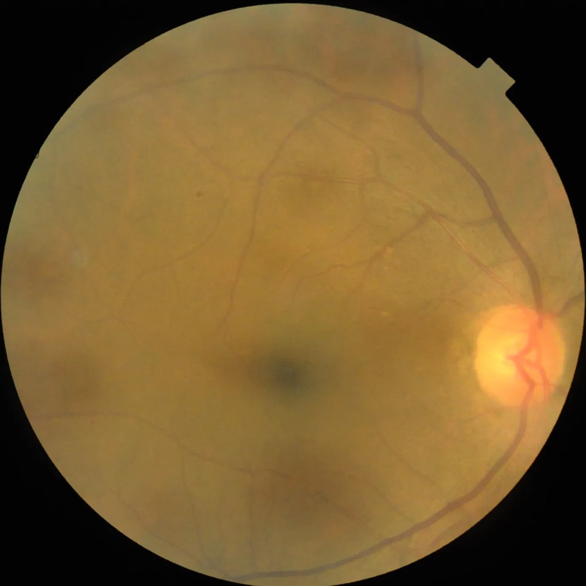Multi-LabelRetinalDiseases_7.webp