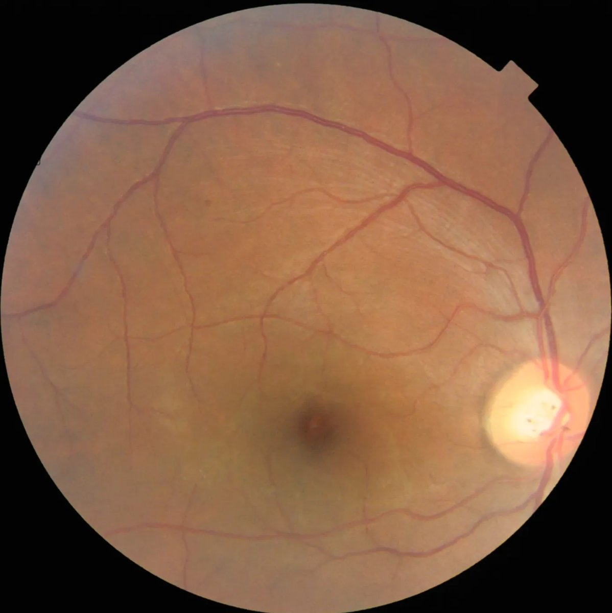 Multi-LabelRetinalDiseases_4.webp