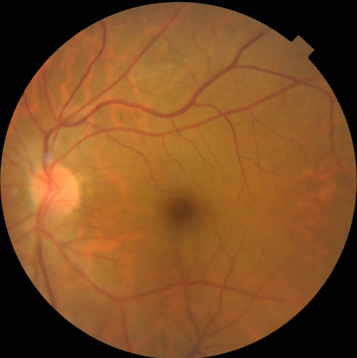 Multi-LabelRetinalDiseases_5.webp