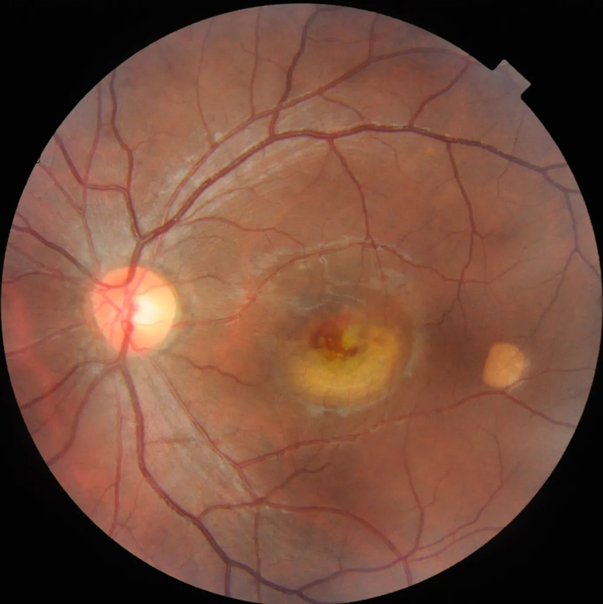 Multi-LabelRetinalDiseases_6.webp