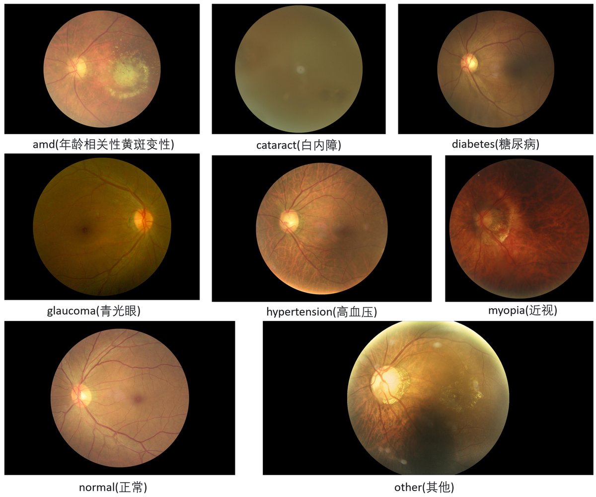 OcularDiseaseRecognition_1.png