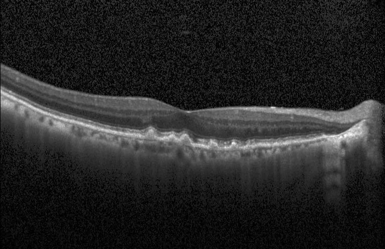 Retinal_OCT-C8_6.webp