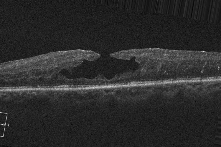 Retinal_OCT-C8_7.webp