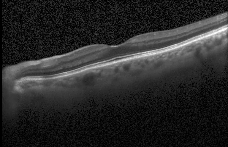 Retinal_OCT-C8_8.webp