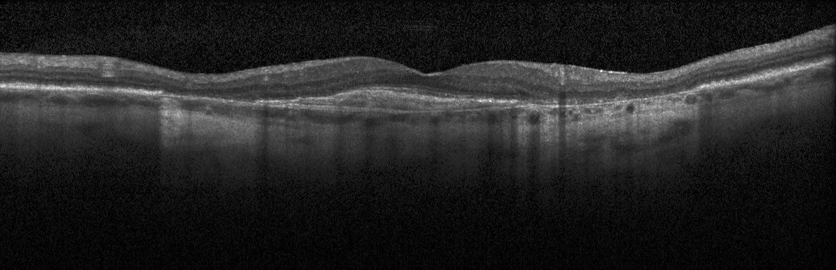Retinal_OCT-C8_2.webp
