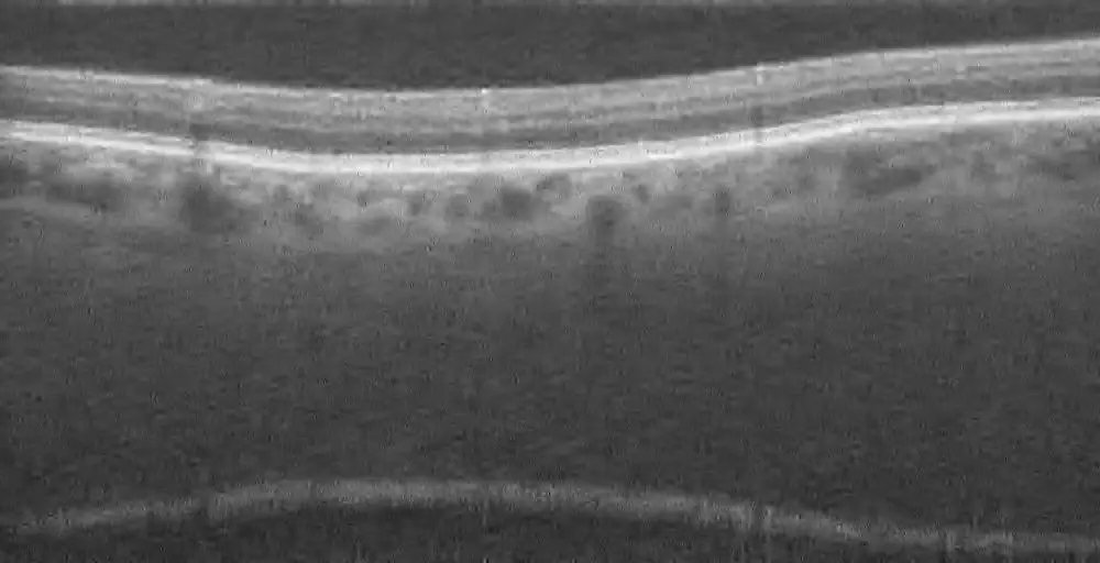 Retinal_OCT-C8_1.webp