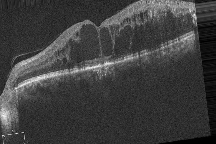 Retinal_OCT-C8_5.webp
