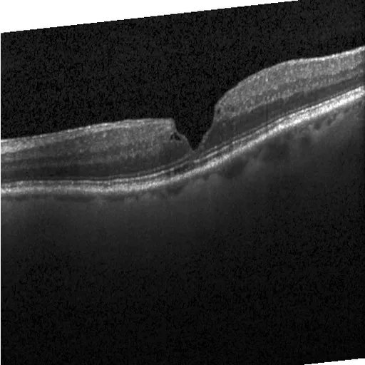 Retinal_OCT-C8_4.webp