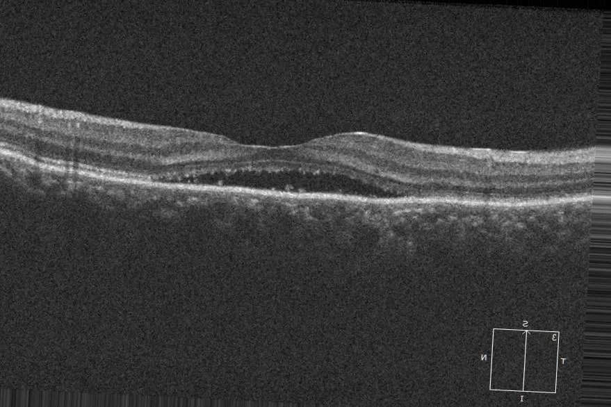 Retinal_OCT-C8_3.webp