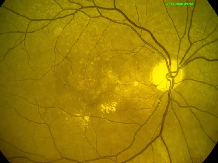 Retinal_QA_1.webp