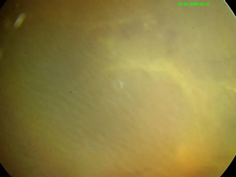 Retinal_QA_2.webp
